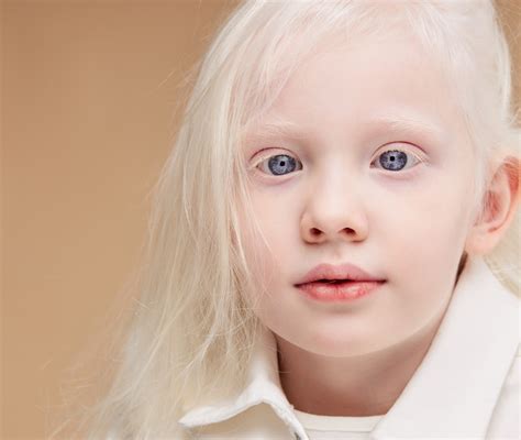 uomo albino|Albinismo: che cosè, cause e indicazioni utili